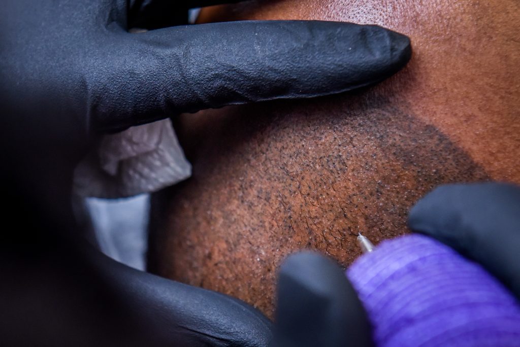 Scalp Micro-pigmentation of bald African-American man