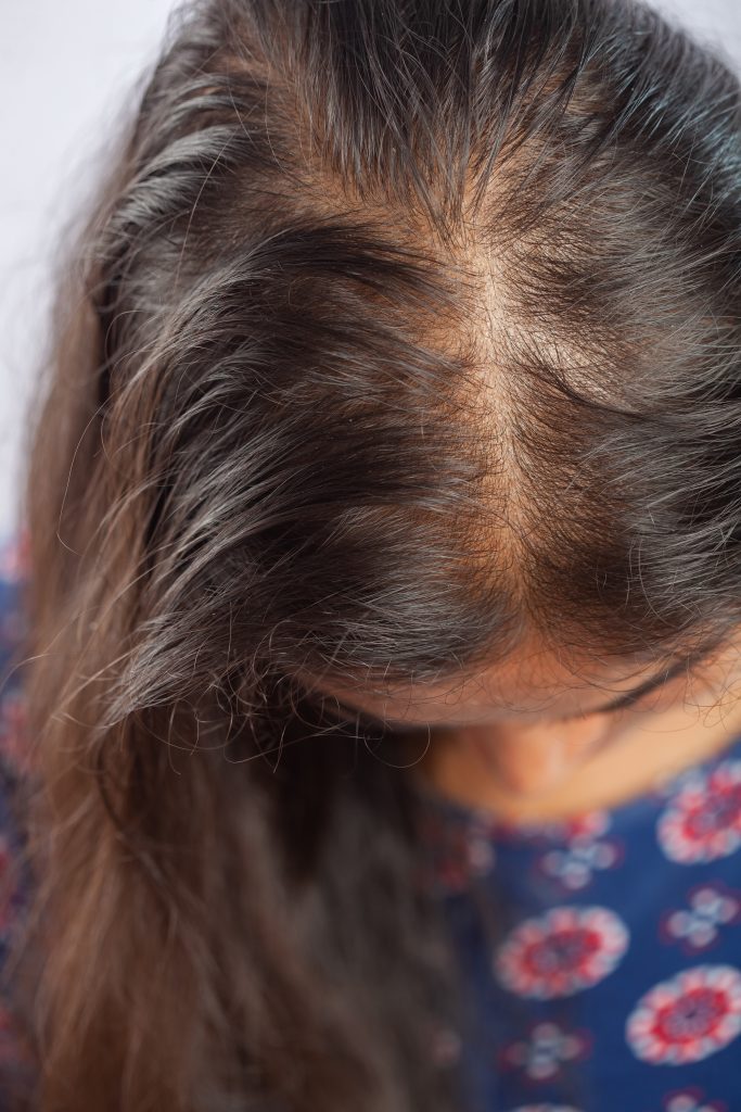 Female Pattern Hair Loss