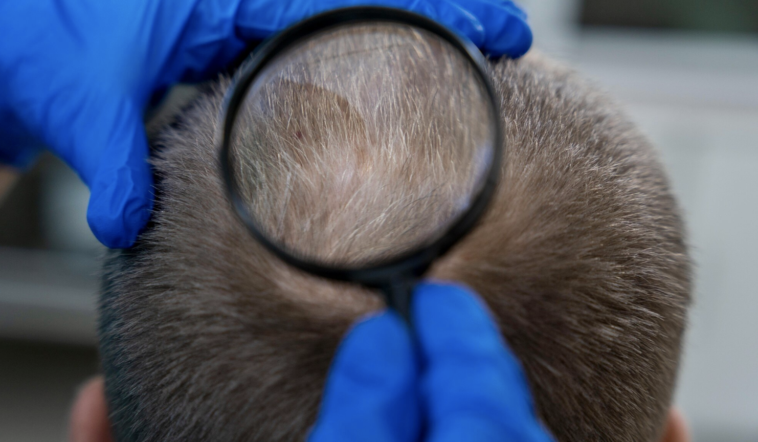 Hair Restoration After Burns A Comprehensive Guide to Burn Hair Transplant