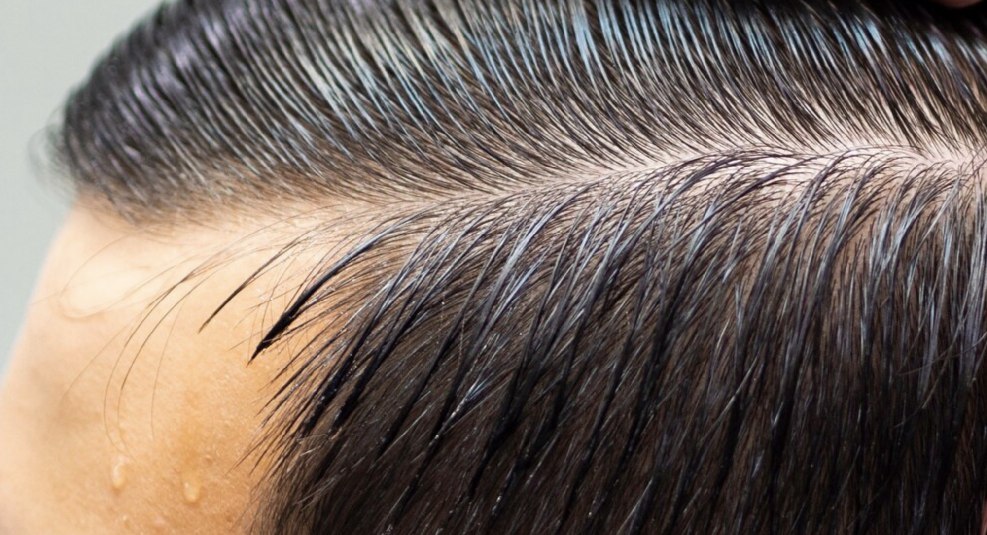 The Ultimate Guide to Hairline Reconstruction: Everything You Need to Know