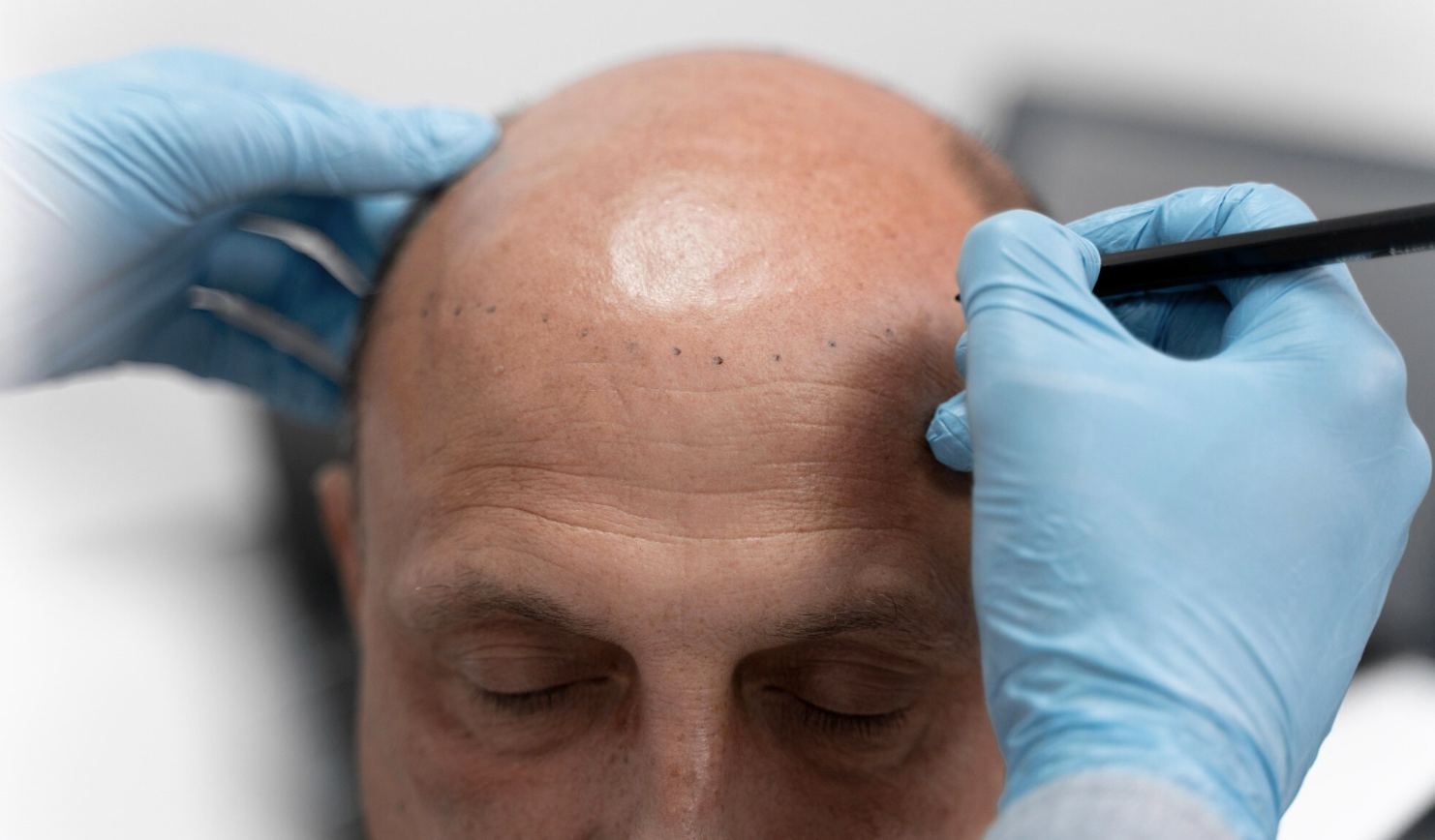 Understanding Minimal Scar Hair Transplant A Comprehensive Guide