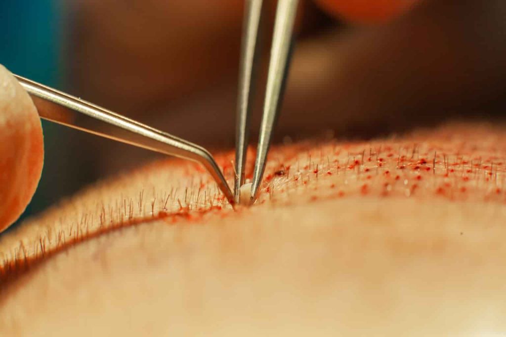 FUE Hair Transplant clinic 